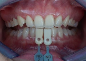 Veneer